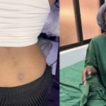 Lady lands in the hospital after getting a back dimple piercing